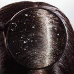 How to Get Rid of Dandruff Fast, Permanently and Naturally (Home Remedies for Dandruff)