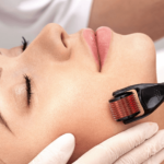 Can derma roller remove acne scars?