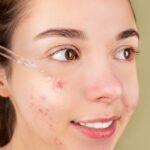 Natural Acne Skin Care