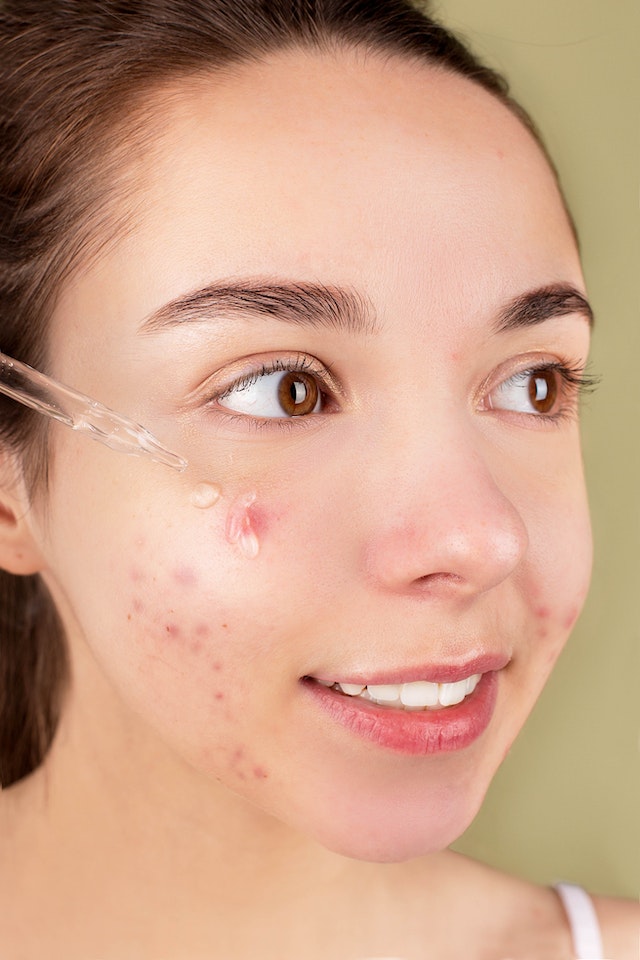 Natural Acne Skin Care
